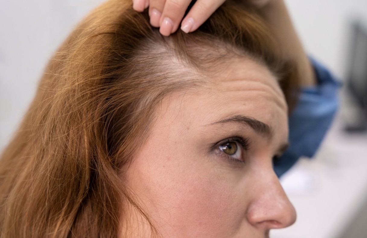 อาการผมบางและผมร่วงจากความผิดปกติของรากผมImage :&nbsp;2149152751.jpg